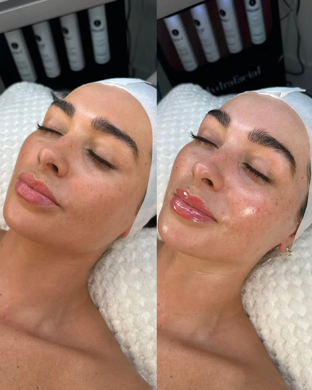 lactic acid peel treatments