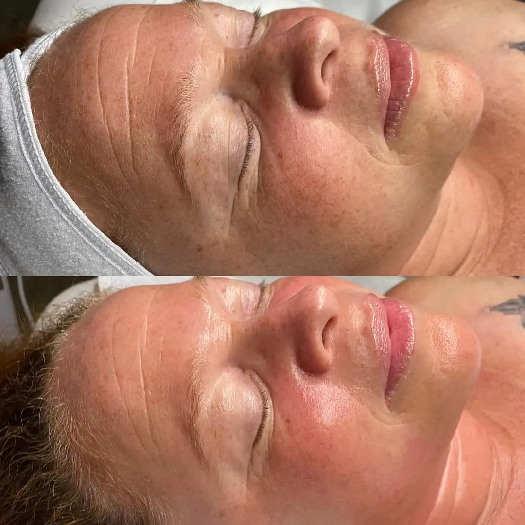 oxygen facial gold coast before & after